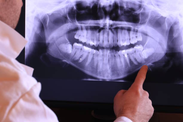 Best Emergency Wisdom Teeth Removal in Kingsland, TX